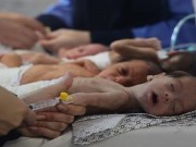 ارتفاع ضحايا سوء التغذية في قطاع غزة إلى 30 مواطنا